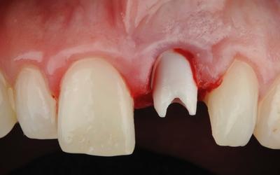 第一次手术未在牙齿 #21 (FDI)/#9（美国）周围实现所需的软组织效果。必须执行第二次校正手术，进一步向切端移动牙龈边缘。