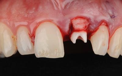 基台用作牙龈粘膜手术的基准。