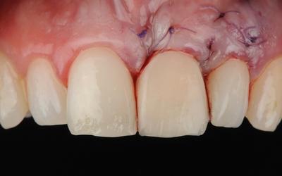 进行牙龈粘膜校正手术并放置临时牙冠后的软组织状况。