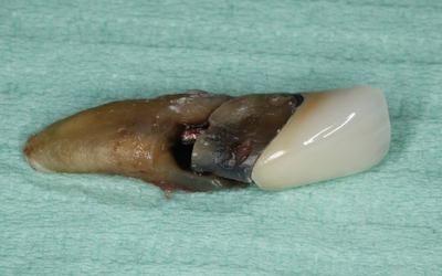 Extracted tooth with apical fractured root segment.