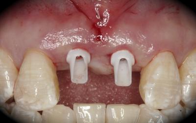 Placement of customized abutments.