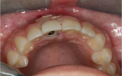 Delivery of screw-retained provisional crown.