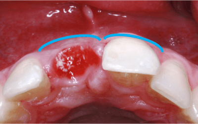 Occlusal view after removal of the provisional bridge 3 months after implant insertion. Note the missing buccal volume.