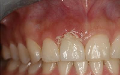Immediate implant placement and provisional restoration.