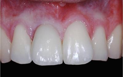 Frontal view of the definitive screw-retained single crown. Veneered zirconia ASC abutment. Teeth # 12,21 (FDI) / 7,9 (US) were treated with composite fillings in order to achieve a better width/length crown ratio.