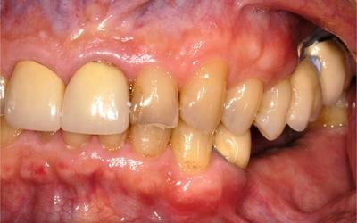 Buccal osseous resorption.