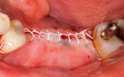 Closure of flap with continuous mattress suture.