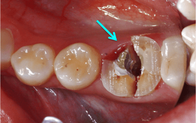 Clinical situation after decoronation and root separation. The arrow indicates the exposure of the undermining decay.
