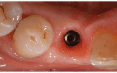 Occlusal view of the soft tissue before impression taking. The soft tissue is perfectly healed and shows the adequate emergence profile.