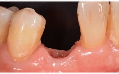 Buccal view of the soft tissue situation before impression taking.