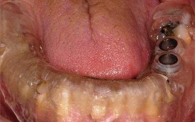 Adjustment of surgical template intraorally.