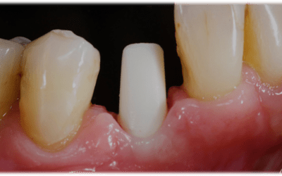 Screw-retained zirconia abutment placed on implant.
