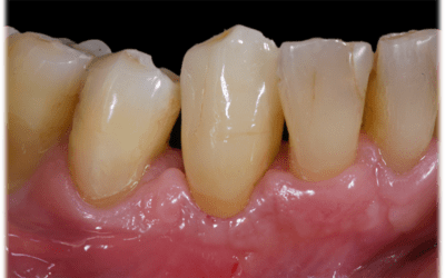 Definitive lithium disilicate single crown bonded onto the zirconia abutment. 