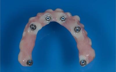 Intaglio view of modified existing denture, now used as fixed-removable provisional denture.