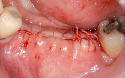 Closure of site with resorbable suture.