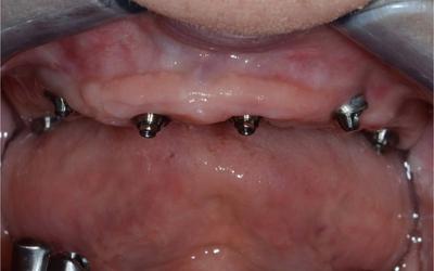 Intraoral view 6 weeks after surgery.