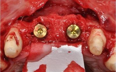 NobelActive implant placement and new autologous bone graft: occlusal view