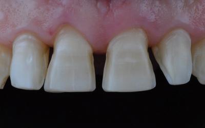 View of anterior teeth after minimally invasive preparation for veneers.