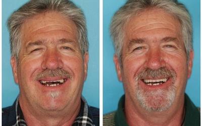 Frontal view of the face before (left) and after the treatment (right).