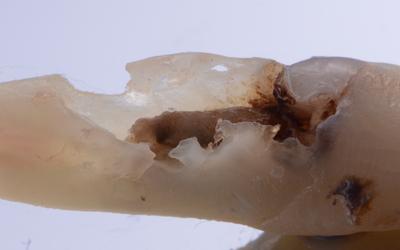 Extracted tooth #12 (FDI) / #7 (US) with resorbed root.
