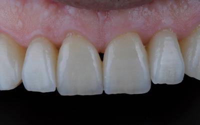 Close-up view of the anterior maxillary teeth after their restoration.