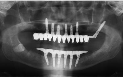 Post-op panoramic radiograph with restoration: mandible with implant bridge type "wrap around", acrylic teeth and acrylic gingival veneer. Maxilla with Nobel Procera implant bridge with individual Nobel Procera crowns and a customized acrylic gingival ven