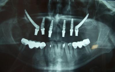 Post-op panoramic radiograph.