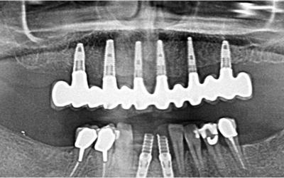 Post-op panoramic radiograph with restoration.