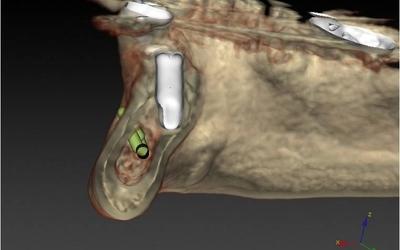 Final implant position #35 (FDI).