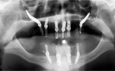 Immediate postoperative radiograph - completed procedure: Removal of the exisiting teeth with placment of implants and immediate loading the maxillary and mandibular implants.