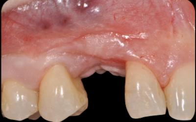 Initial clinical situation. The pre-operative buccal view is showing a missing canine associated with mucogingival deformities as the results of a traumatic extraction of the retained canine. A bone graft was attempted as well as an implant insertion: both bone graft and implant failed.