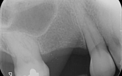 The peri-apical radiograph is showing a pneumatized sinus, mesial positioning of tooth #16 FDI (#3 US) and a deep notch on the buccal of #13 FDI (#6 US). 