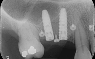 Post-op periapical radiograph with 2 Nobel Parallel Conical Connection (CC) Narrow Platform (NP), 11.5 mm in length. 