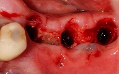 Immediate removal of implants by reverse torque.