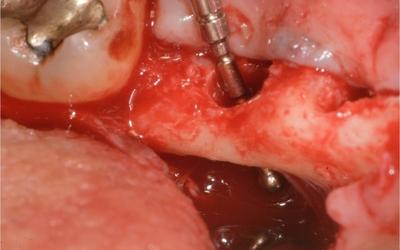 Evaluation of osteotomies.