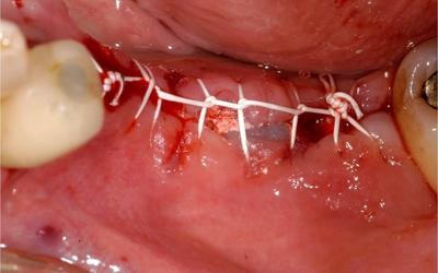 Primary closure with mattress suture.