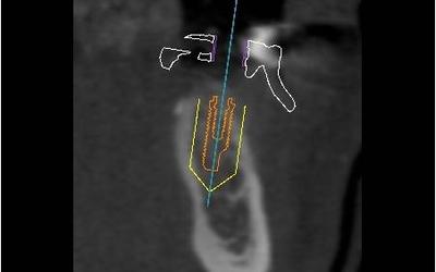 Planned implant for #35 (FDI).