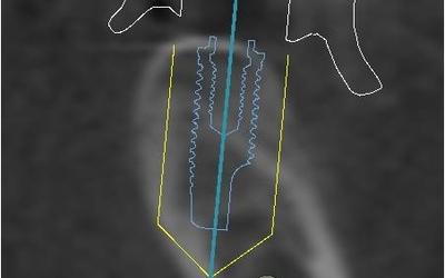 Planned implant for #36 (FDI).