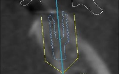 Planned implant for #37 (FDI).