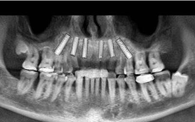 Panoramic radiograph with planned positions of implants.