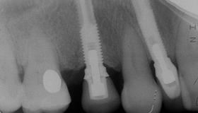 Is the implant close to other teeth or implants?