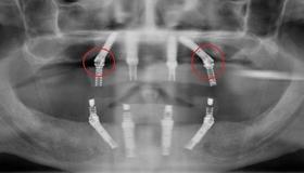 Is there lack of passive fit or prosthetic component loosening?