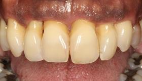 Does the patient have a history of periodontitis?