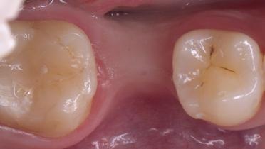 2 Occlusal view