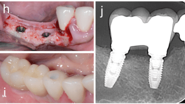 Implants After GBR with Wound Dehiscence