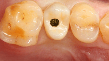 Implant