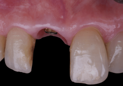 Final soft tissue image: buccal view