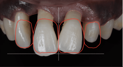 central incisor