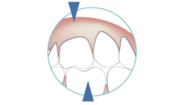 2125-occlusal-schemes.png