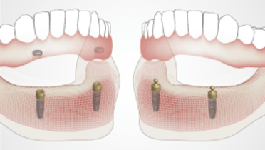 2340-thumb-retention-devices.png